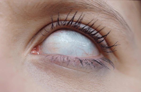 deceased eyes