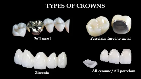 price of dental cap